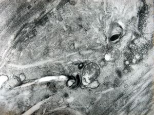 M,3y. | globoid leukodystrophy of Krabbe - n.suralis